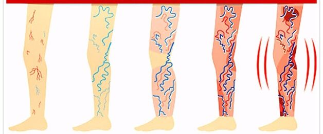 ce sa nu faci cu venele varicoase