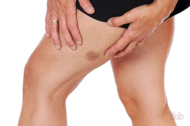 dacă o venă sparge