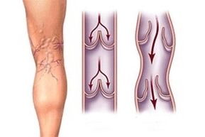 fluxul de sânge în vene varicoase în diferite stadii de dezvoltare a bolii